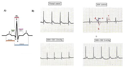 Image result for Normal ECG Interval Values