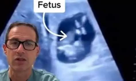 Viral Video of Ectopic Pregnancy with baby in liver draws million views