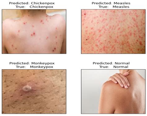 TMS: Ensemble Deep Learning Model for Accurate Classification of ...