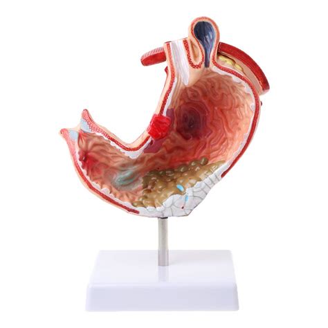 Buy jiken Human Anatomical Anatomy Stomach Medical Model tric Pathology ...