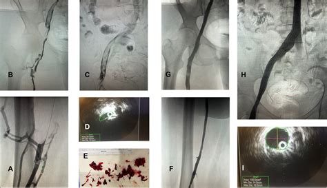 Initial Experience with the Ambulatory Management of Acute Iliofemoral Deep Vein Thrombosis with ...