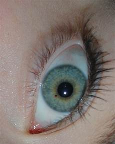 dunkle punkte im braauner fleck im auge gesundheit augen dunkle punkte im braauner fleck im auge gesundheit augen