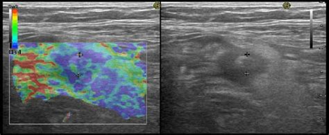 Image result for Perforated Appendix