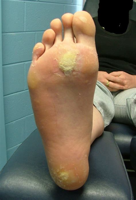 foot hpv