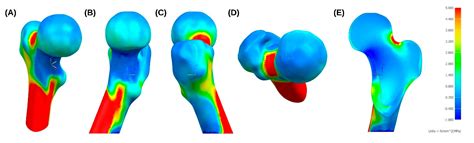 Biomechanical Study of Proximal Femur for Designing Stems for Total Hip ...