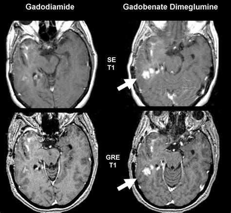 Contrast-Enhanced MR Imaging of Brain Lesions: A Large-Scale Intraindividual Crossover ...