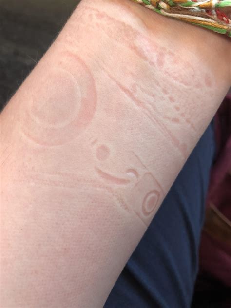 Sleep Lines On Arm at Michael Stover blog