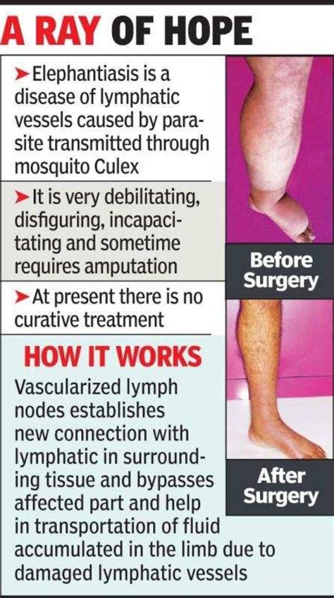 Central India’s 1st surgery on elephantiasis done in Nagpur | Nagpur ...