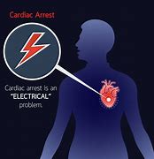 Image result for cardiac arrests