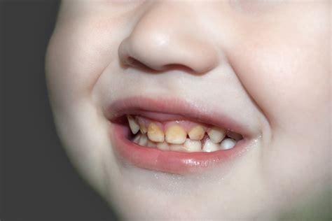 Tooth decay in children: How to prevent, spot and treat it