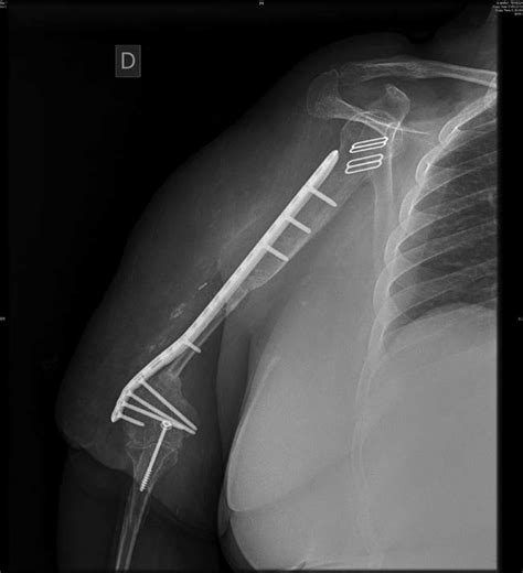 X-ray at 6 months showing bone healing. | Download Scientific Diagram