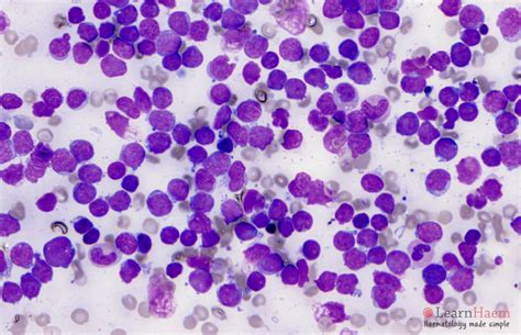 Acute Luekemia Ymphatic Images Retrained T Cells Cause Cancer