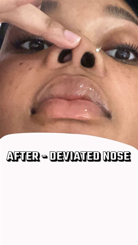 Jaw surgery ruined my face (before/after) : r/jawsurgery