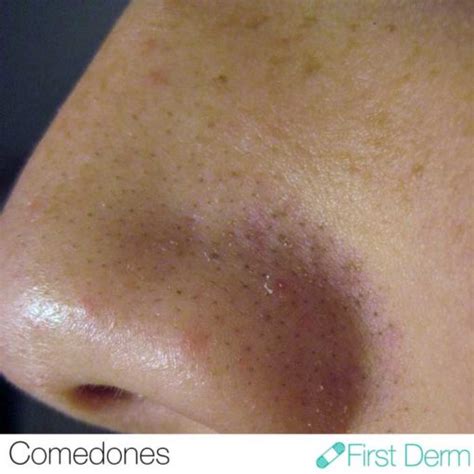 Image result for Sebum Plug Extraction