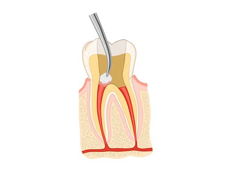 Pulpotomy vs. Pulpectomy - My Dental Key