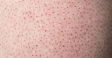 What is Strawberry Skin and How to Treat It? | Clinikally