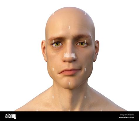 Bell's palsy, a unilateral facial paralysis, computer illustration. The ...