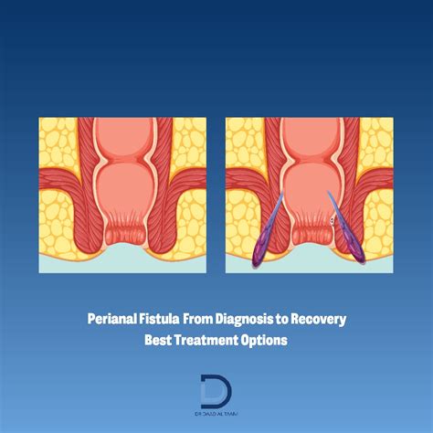 The Difference Between Anal Fissure & Anal Fistula: Causes, Symptoms ...