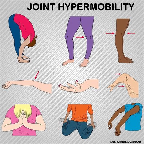 Hypermobility – Artofit