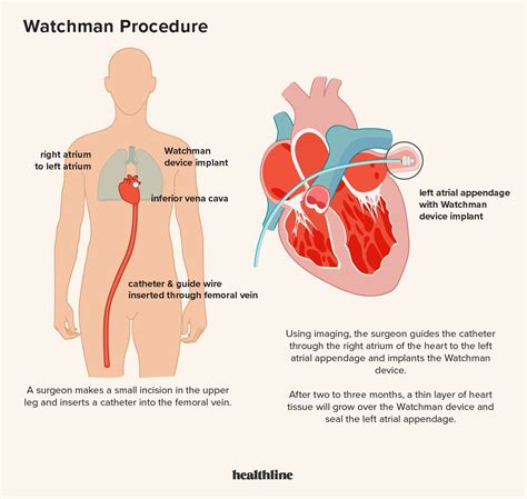 심방세동(AFib)에 대한 Watchman 장치 및 절차 - 최신