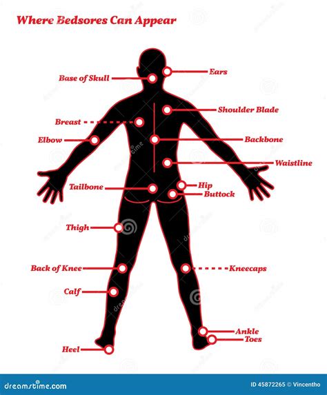 Pressure Sores Bedsores Ulcers Human Anatomy Illustration Stock Vector ...