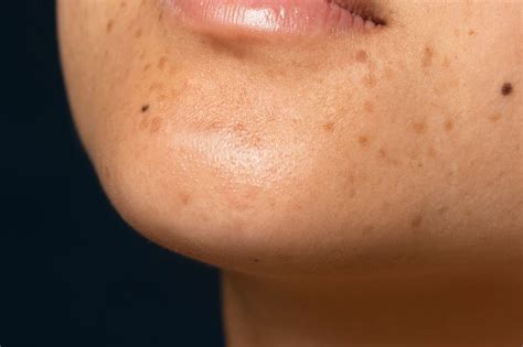 Sun Damaged Skin (Photoageing): A Complete Guide