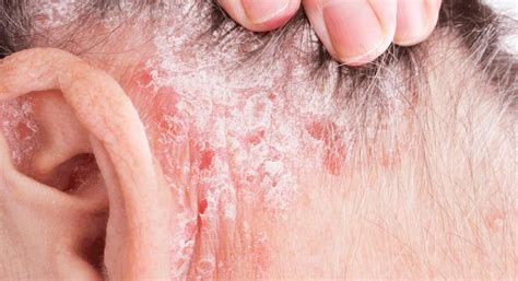 scalp psoriasis – Dr.JRK's Research and Pharmaceuticals