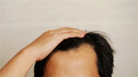 Hair Fall Causes: 5 causes of baldness in men and how to treat it