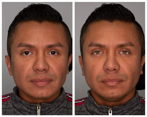 Image result for Eye Color Surgery