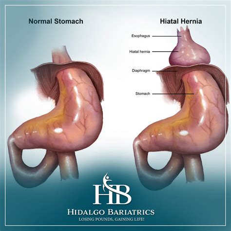 7 Essential Benefits of Hiatal Hernia Repair in Bariatric Surgery: What Bariatric Patients Need ...