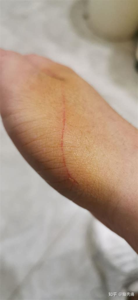 徐冬冬晒出手部被猫抓伤的照片，两条血痕十分明显！……