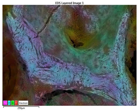 SEM-EDX Analysis of Metal Particles Deposition from Surgical Burs after ...