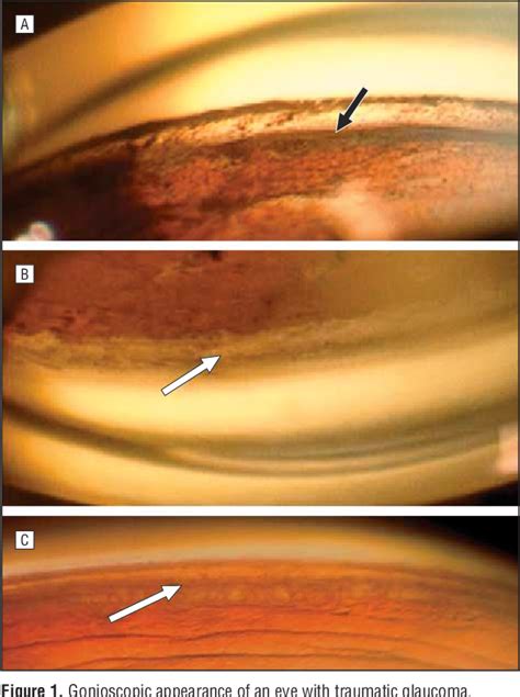 Angle Recession 的图像结果