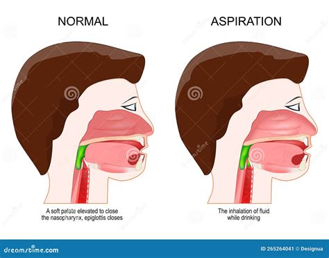 Dysphagia Outcome And Severity Scale Printable - prntbl ...