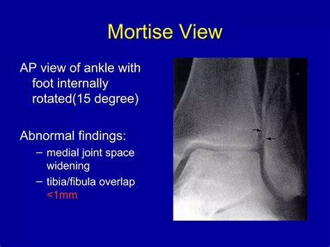 Ankle injury amanj | PPT