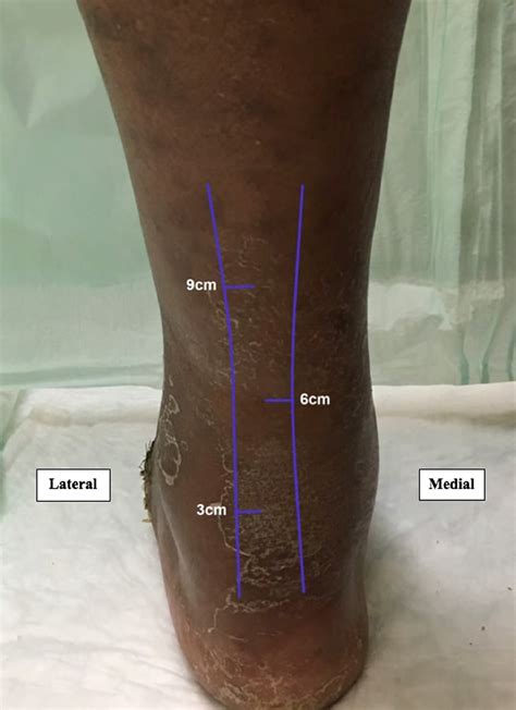 Plantar Foot Ulcer Recurrence in Neuropathic Patients Undergoing Percutaneous Tendo-Achilles ...