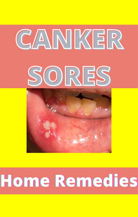 Canker Sore Home Remedies