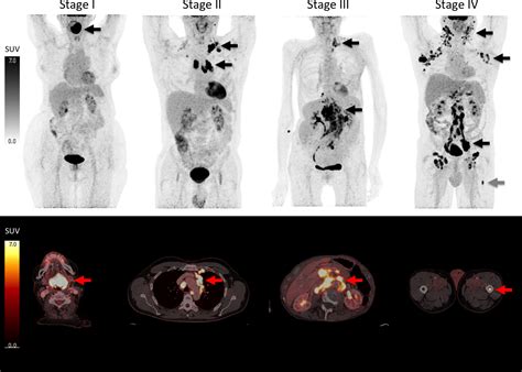 Pet Scan Lymphoma Stage Iv Recent Updates Of PET In Lymphoma: FDG And