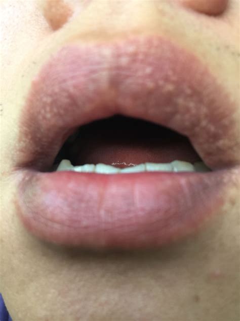【嘴唇过敏性皮炎】【图】嘴唇过敏性皮炎怎么办 几种方案应对嘴唇过敏(3)_伊秀健康|yxlady.com