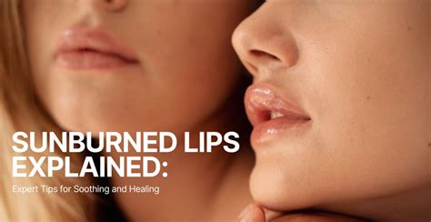 Sunburned Lips: Simple Cures and Prevention Tips