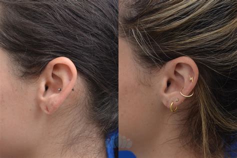 Earlobe Repair Before and After Pictures Case 77 | Charlotte, NC | Dilworth Facial Plastic Surgery