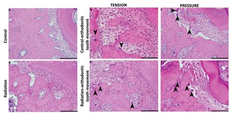 The Balance between Orthodontic Force and Radiation in the Jawbone ...