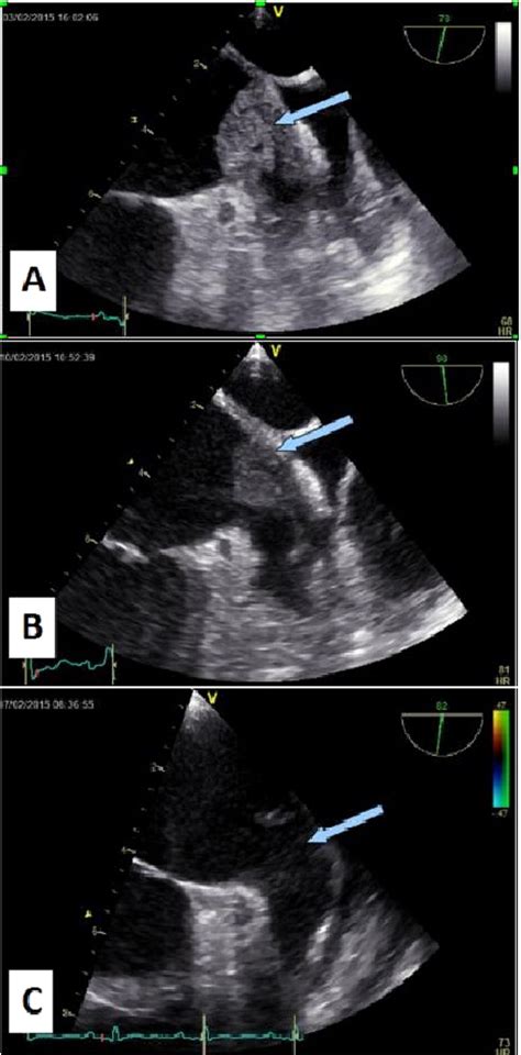 A fortunate outcome after electrical cardioversion with a giant persistent left atrial thrombus ...