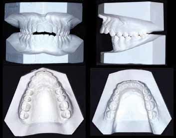 Image result for How to Take Study Models with Plaster Lab