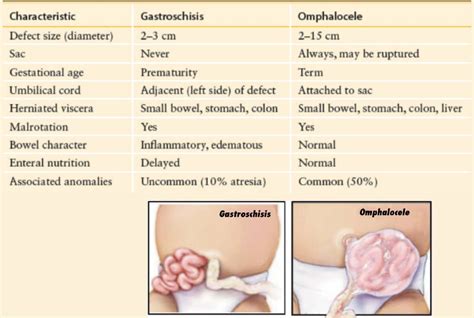 Difference between Gastroschisis and Omphalocele | Medical knowledge ...