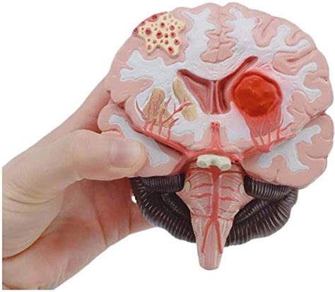 Buy Brain Model Brain Structure malformed pathological cerebral cortex ...