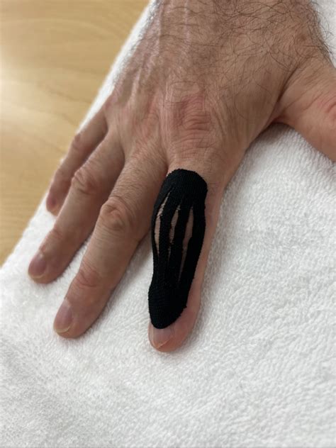 Image result for Finger Dislocation Reduction