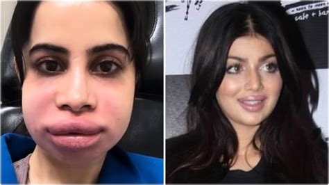 Cosmetologist breaks down celebrity filler craze: From baby botox to ...