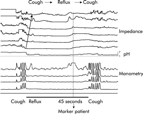 Weakly acidic reflux in patients with chronic unexplained cough during ...