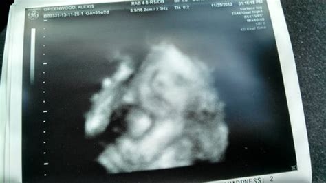 what's the numbers followed by cm/hz on top of a ultrasound? | BabyCenter